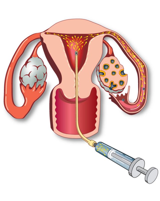 intra uterine insemination