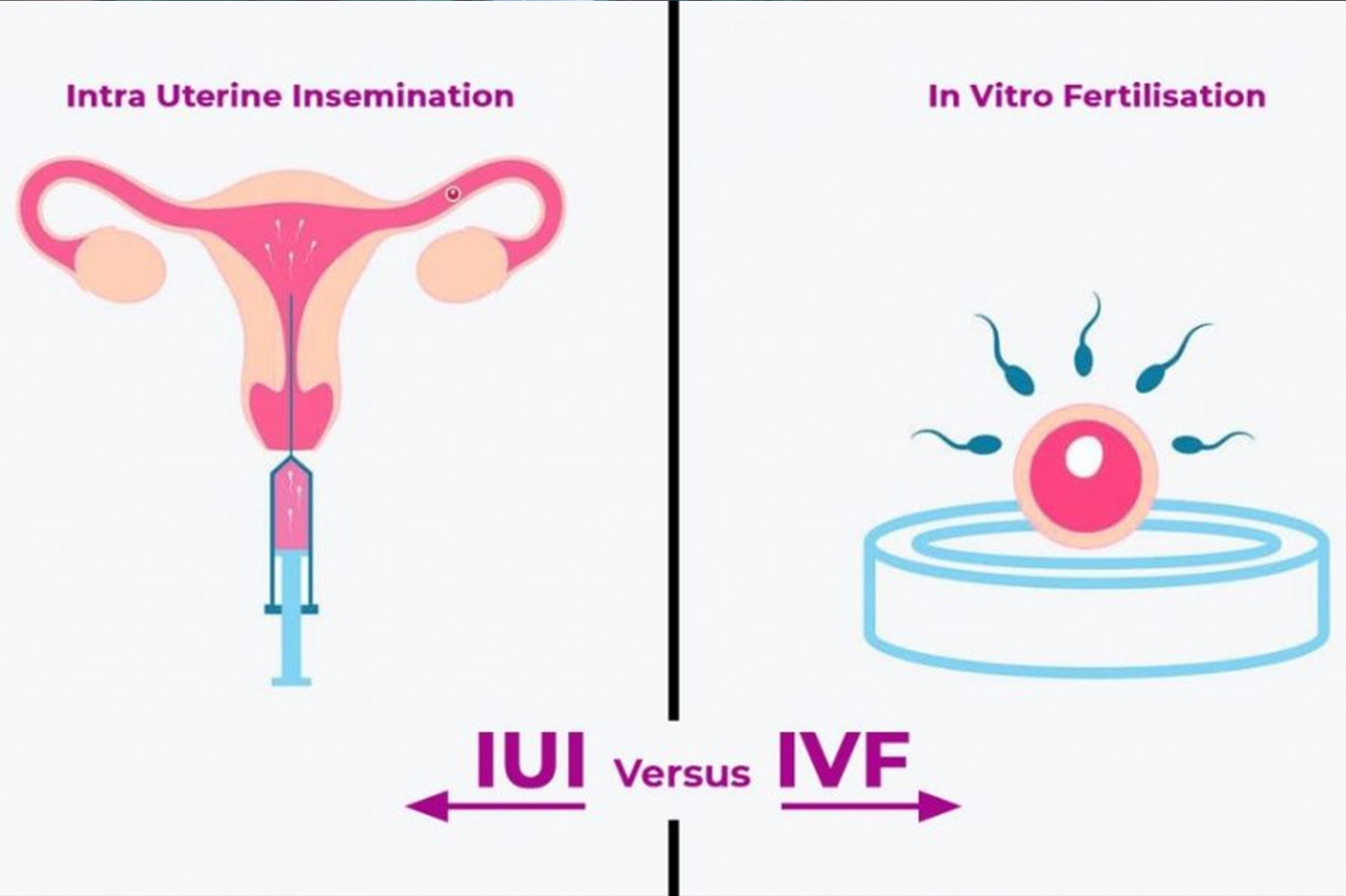 Difference Between Ivf And Artificial Insemination