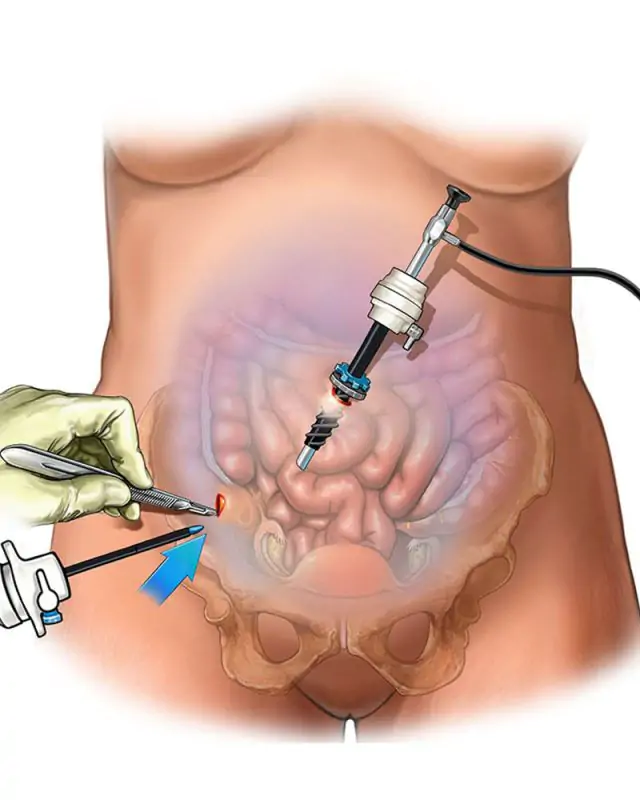 Laparoscopy | Pahlajanis laprocopy service