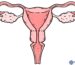 Ovarian Cysts