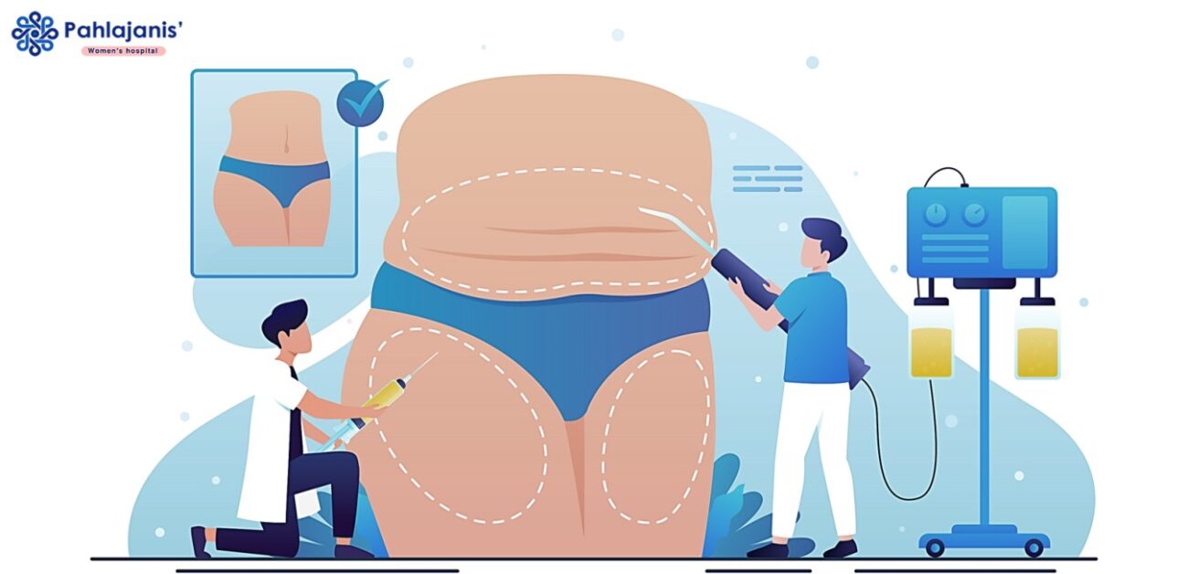 TAH - Total Abdominal Hysterectomy