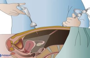 Diagnostic Hystero Laparoscopy - Illustration