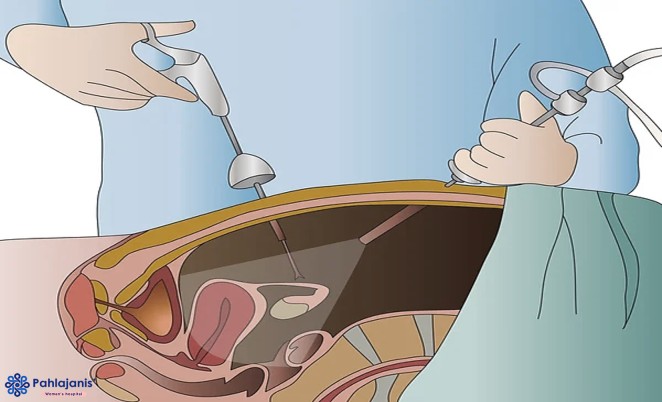 Diagnostic Hystero Laparoscopy - Illustration