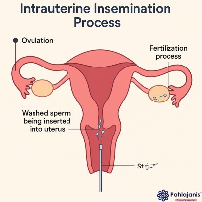 IUI Treatment in Bhilai - IUI Process