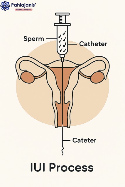 Struggling to Conceive? Here’s How a Fertility Doctor in Raipur Can Help | Pahlajanis Fertility Doctor in Raipur - IUI